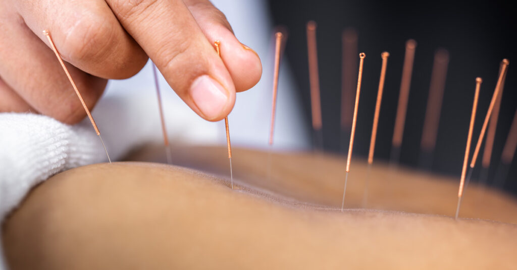 acupuncture