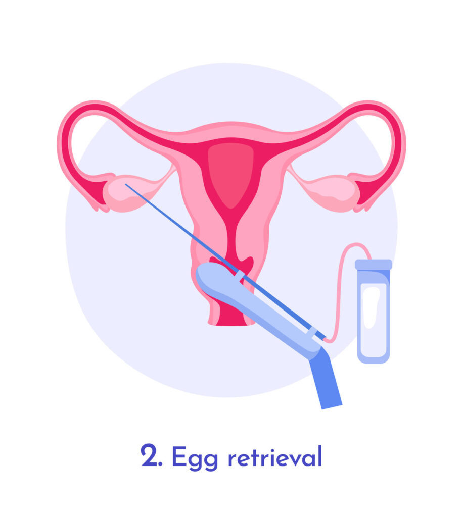 Medical diagram showing the egg retrieval process in assisted reproductive technology, flat graphic style, light background. Concept of IVF procedure. Vector illustration